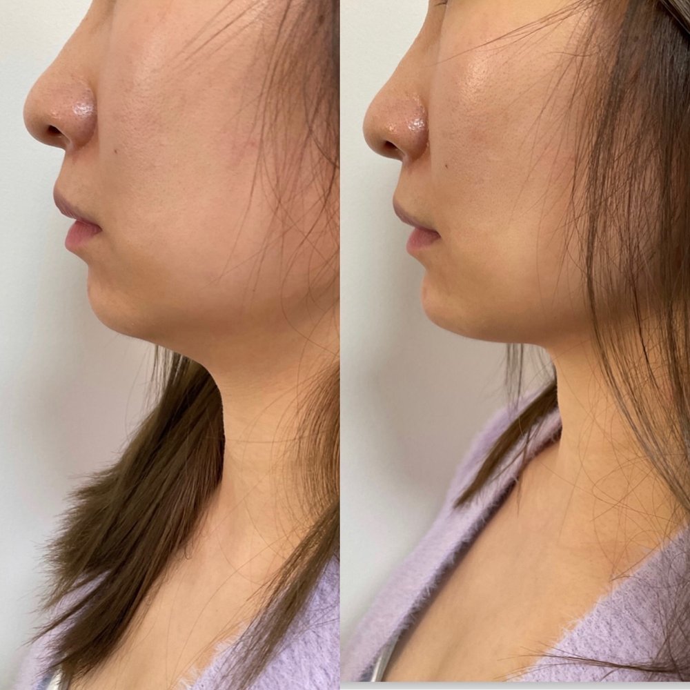 cosmetic injections, Botox Treatment