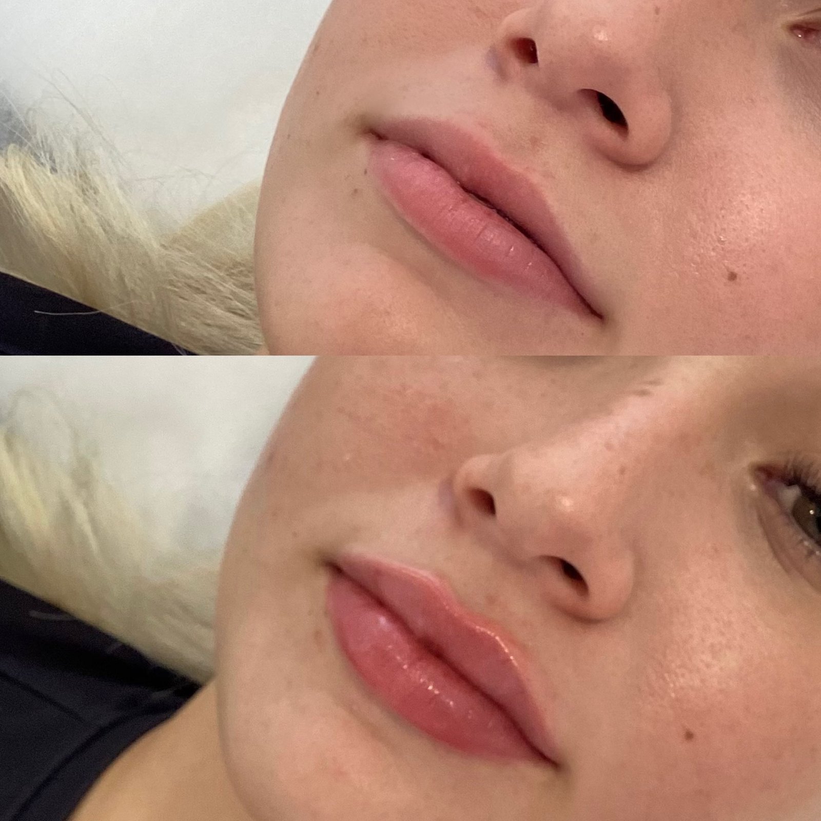 LIP ENHANCEMENT